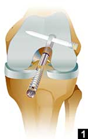 Các phương pháp cố định mảnh ghép trong phẫu thuật tạo hình dây chằng khớp gối